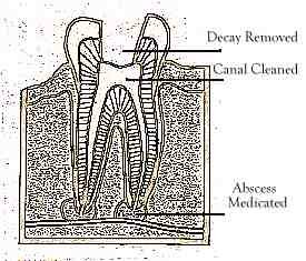 Root Canals Reamed