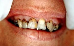 Before veneers - JPG 12Kb